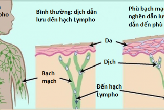 PHÙ BẠCH HUYẾT Ở BỆNH NHÂN UNG THƯ: DẤU HIỆU, TRIỆU CHỨNG VÀ NHỮNG ĐIỀU CẦN LƯU Ý